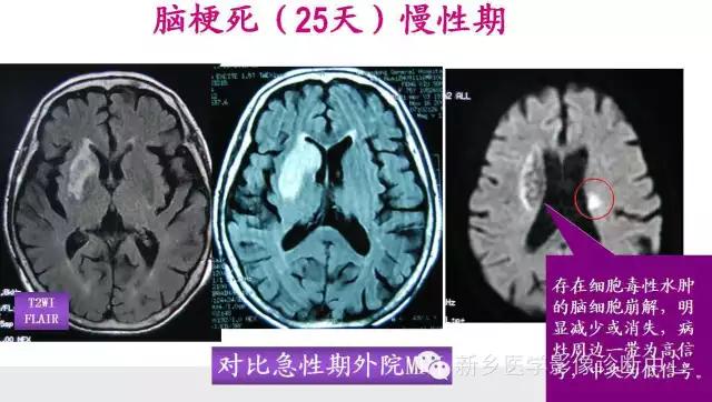 脑梗塞分期最新标准全面解析，从初期到后期，你需要知道的步骤指南