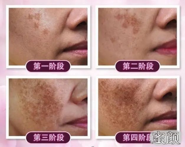 最新祛斑技术揭秘，重塑肌肤光彩的秘诀
