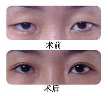 最新双眼皮手术步骤指南详解